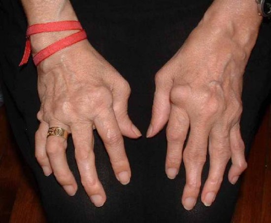 La artritis se da más frecuentemente en la mujer, en una proporción de 7 a 1 en relación al varón.