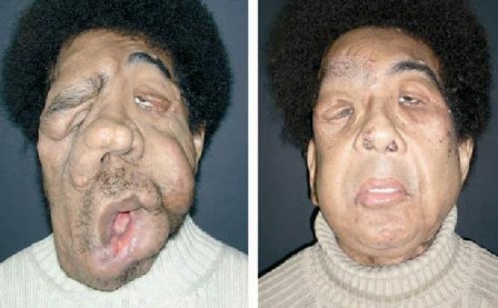 El hombre de 29 aos al que se le efectu en Francia una ciruga de rostro.