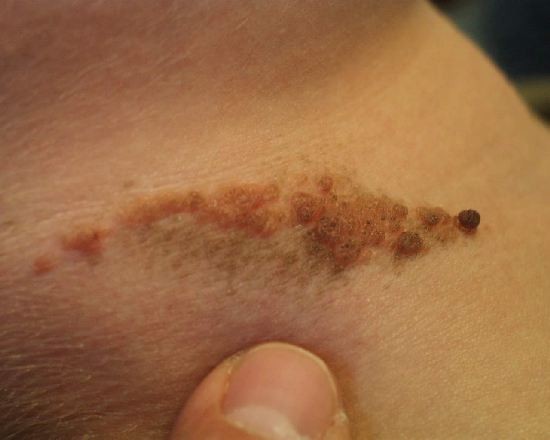 En nuestro pas cada ao se registran unos 1.100 casos de melanoma. 
